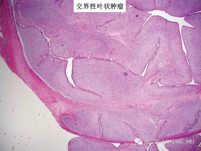 乳腺梭形细胞病变的病理诊断及进展（二）