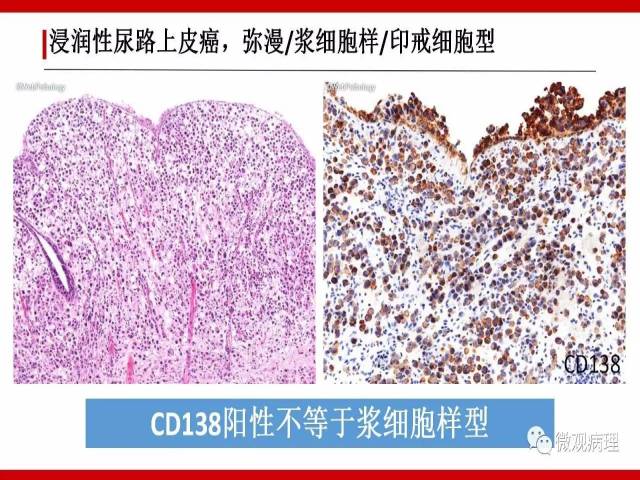泌尿课程/浸润性尿路上皮癌病理学类型