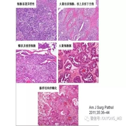 卵巢癌的病理诊断新进展（三）