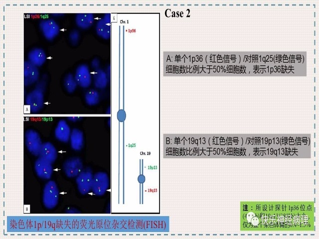 胶质瘤分子结果矛盾时如何整合诊断