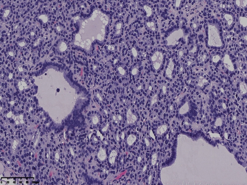 这个甲状腺肿瘤怎么看？