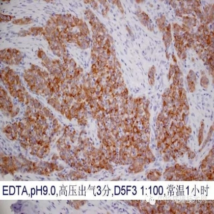 《常规免疫组化初筛ALK阳性非小细胞肺癌专家共识》技术部分解读