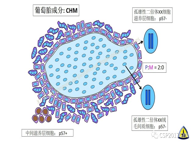 p57免疫组化染色及基因分型 在葡萄胎精确诊断中的应用