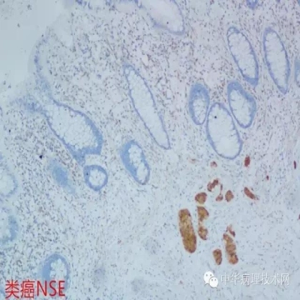 免疫组化结果的分析和常见问题的处理