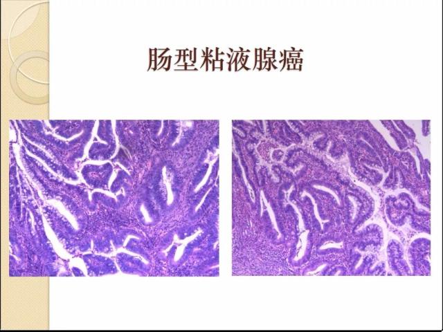 非HPV感染相关性宫颈腺性病变