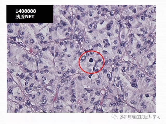 病理学基础知识 : 核分裂像的识别