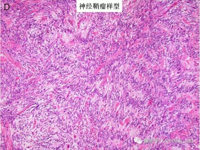 乳腺梭形细胞病变的病理诊断及进展（一）