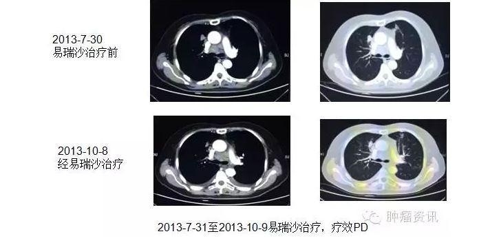 中日韩个体化诊疗案例大赛经典赏析之十——EGFR敏感突变患者，如果TKI原发性耐药，需警惕合并其他驱动基因变异！