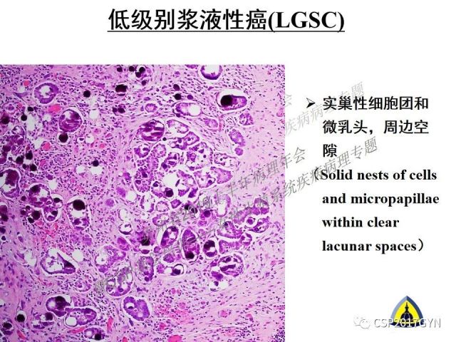 中华病理学会基层培训遵义站讲座（一）——卵巢和输卵管浆液性肿瘤的诊断和鉴别诊断