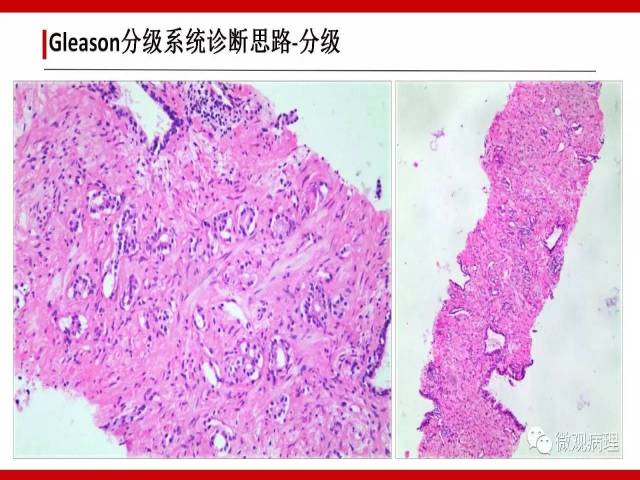 前列腺癌Gleason分级系统的前世今生