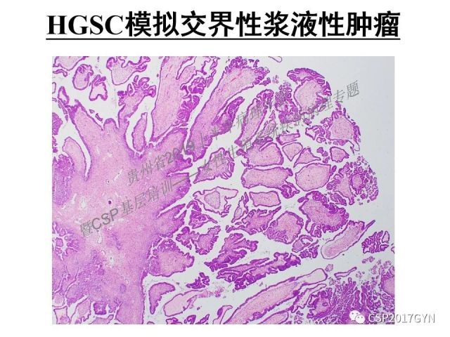 中华病理学会基层培训遵义站讲座（一）——卵巢和输卵管浆液性肿瘤的诊断和鉴别诊断