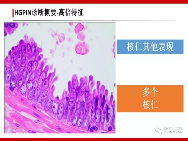 泌尿课程/一个中心,两个基本点:HGPIN诊断概要 泌尿课程/一个中心,两个基本点:HGPIN诊断概要