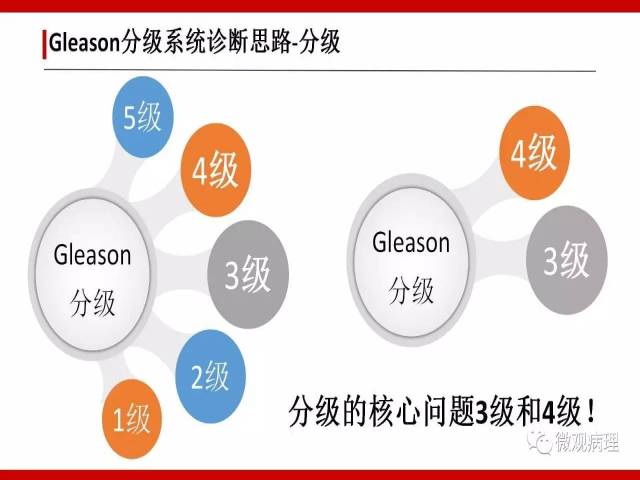 前列腺癌Gleason分级系统的前世今生
