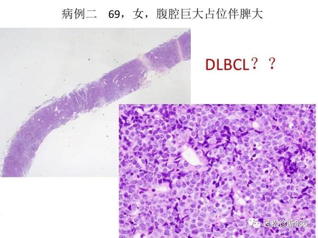 淋巴母细胞淋巴瘤