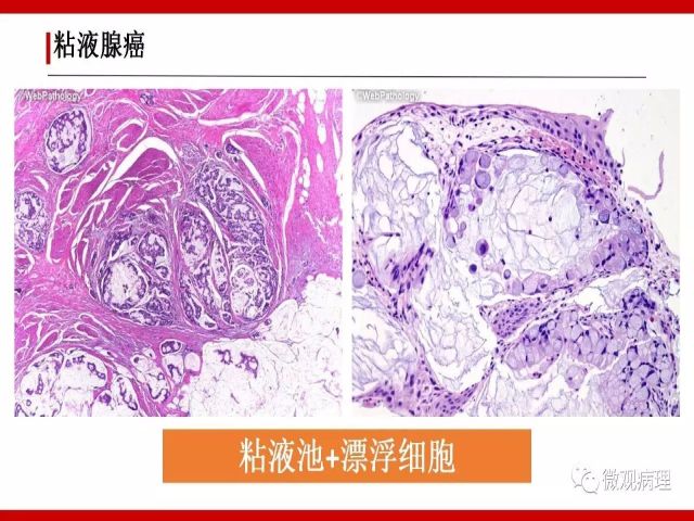 泌尿课程/尿路腺样病变的诊断要点