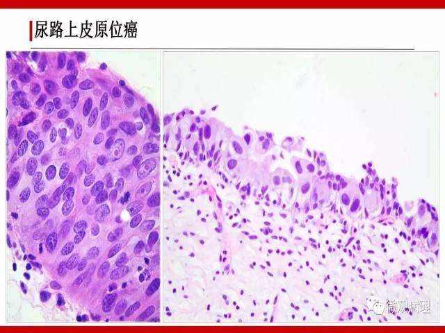 泌尿课程/非浸润性尿路上皮肿瘤诊断公式