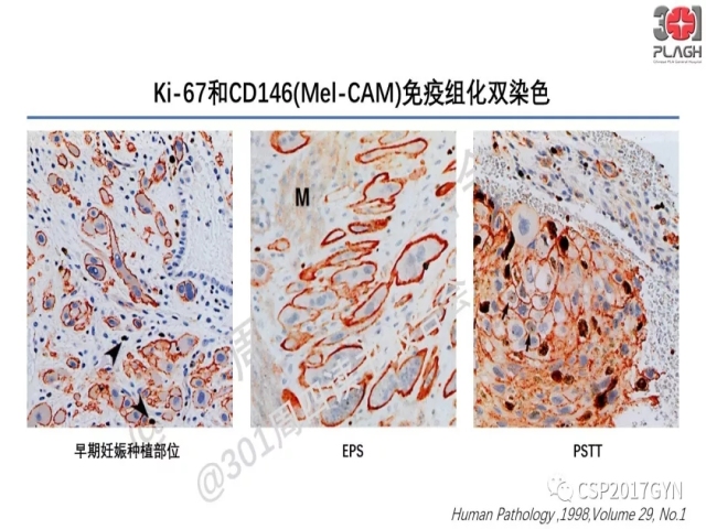 中间型滋养细胞肿瘤的诊断及鉴别诊断