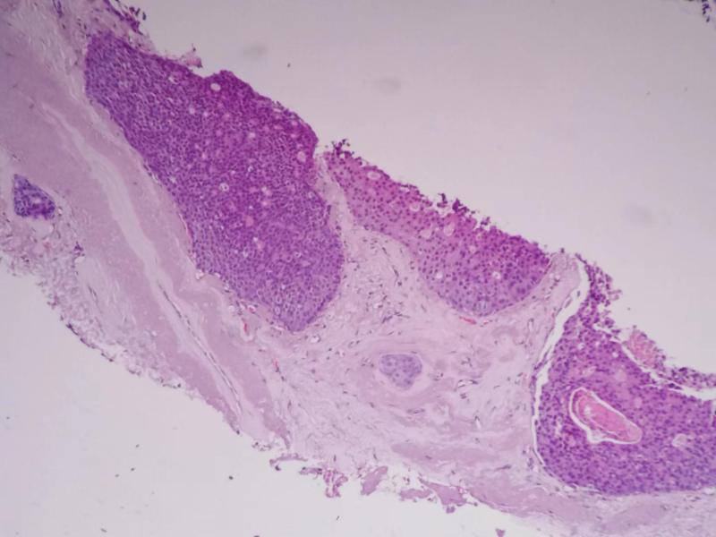 组织学1级的乳腺浸润性导管癌（札记七十五）