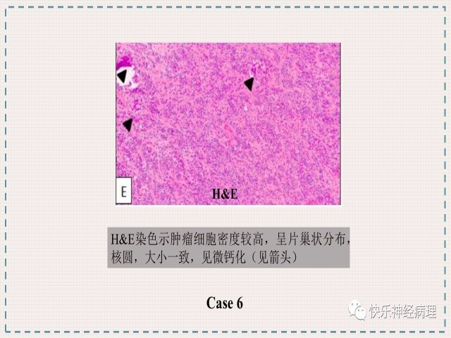 胶质瘤分子结果矛盾时如何整合诊断