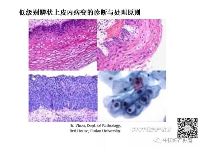 独家专访国内妇产科病理大咖周先荣教授：子宫颈上皮内病变及相关临床情况的若干病理学问题（一）