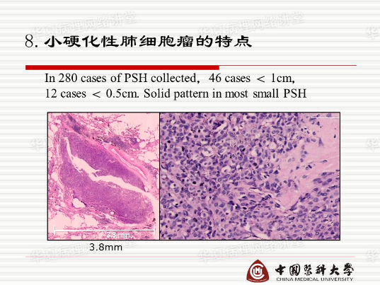 结合实际病例学习《硬化性肺细胞瘤的诊断陷阱》