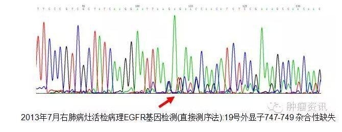 中日韩个体化诊疗案例大赛经典赏析之十——EGFR敏感突变患者，如果TKI原发性耐药，需警惕合并其他驱动基因变异！