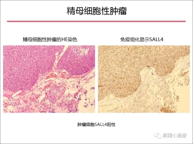 泌尿病理--精原细胞瘤VS精母细胞瘤
