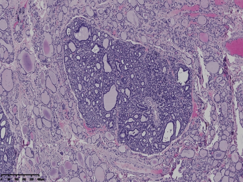 这个甲状腺肿瘤怎么看？
