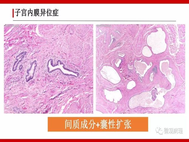 泌尿课程/尿路腺样病变的诊断要点