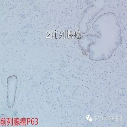 免疫组化结果的分析和常见问题的处理