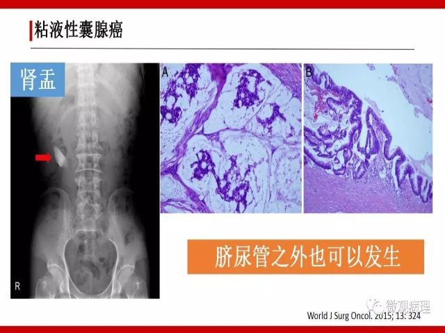 泌尿课程/尿路腺样病变的诊断要点