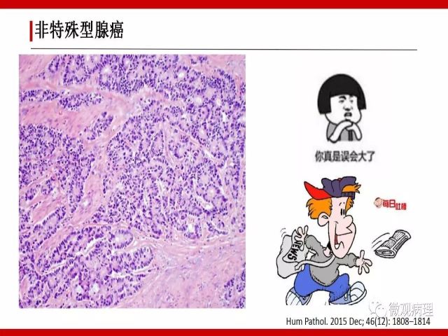 泌尿课程/尿路腺样病变的诊断要点