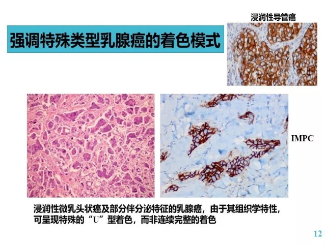 乳腺癌HER2检测指南更新