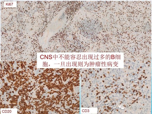 中枢神经系统弥漫大B细胞淋巴瘤