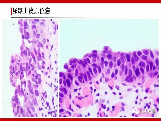 泌尿课程/非浸润性尿路上皮肿瘤诊断公式