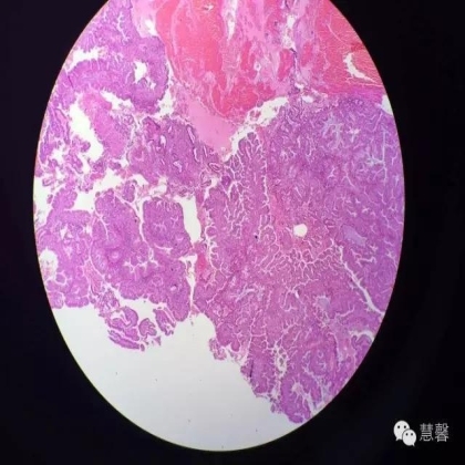 高分化子宫内膜样癌与分泌期子宫内膜、黏液腺癌的鉴别（孔令英分享，刘从容老师讲解）