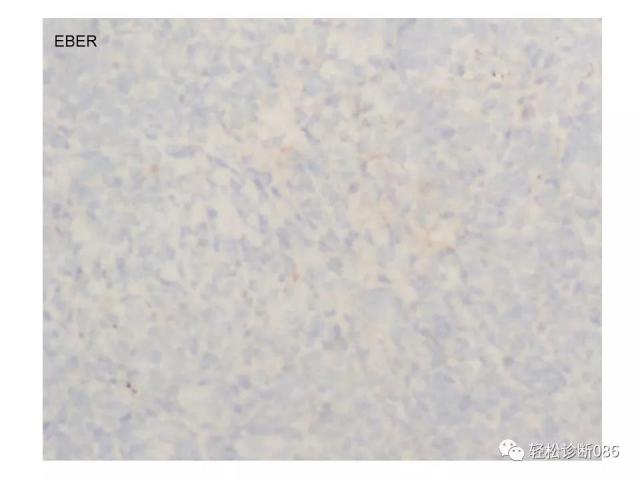 BPDCN病例分享
