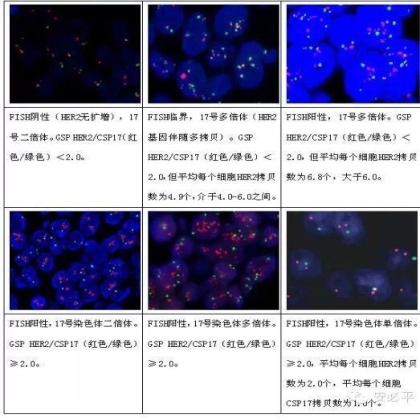乳腺癌HER2 FISH检测——靶向用药的金标准(三) HER2 FISH检测报告及结果解释