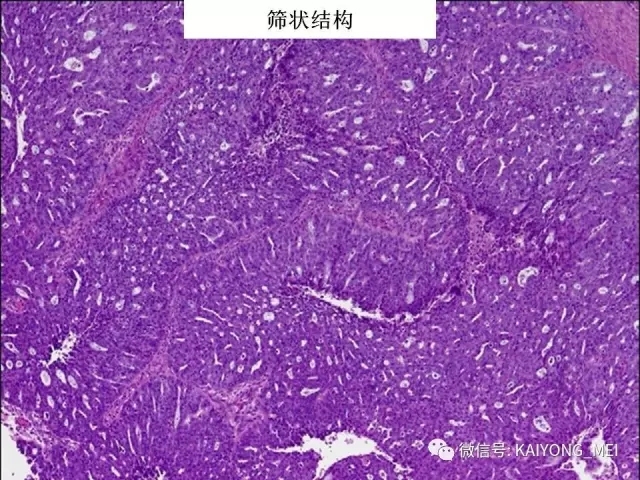 卵巢癌的病理诊断新进展（一）