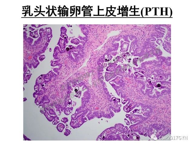 中华病理学会基层培训遵义站讲座（一）——卵巢和输卵管浆液性肿瘤的诊断和鉴别诊断