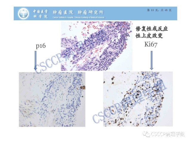 宫颈癌前病变中的诊断难点及阴道镜中ECC的 应用价值