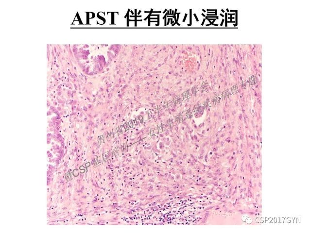 中华病理学会基层培训遵义站讲座（一）——卵巢和输卵管浆液性肿瘤的诊断和鉴别诊断