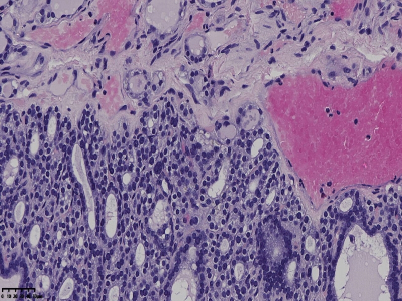 这个甲状腺肿瘤怎么看？