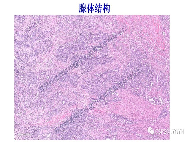 妇科肿瘤病理新进展——特殊类型的腺癌