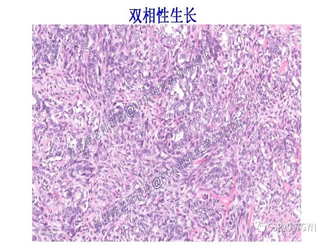 妇科肿瘤病理新进展——特殊类型的腺癌