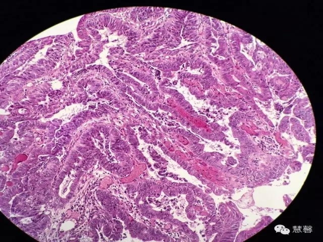 结、直肠管绒毛状腺瘤-高级别病变诊断等相关问题2（悄悄分享、孔祥田(Max)*Roswell*老师讲解）