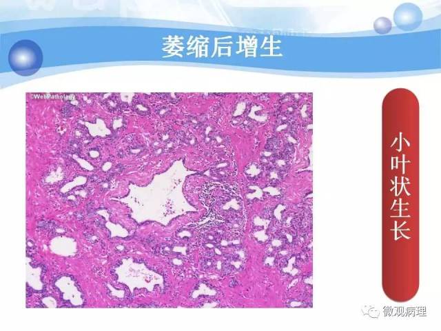 泌尿课程/局灶性前列腺萎缩