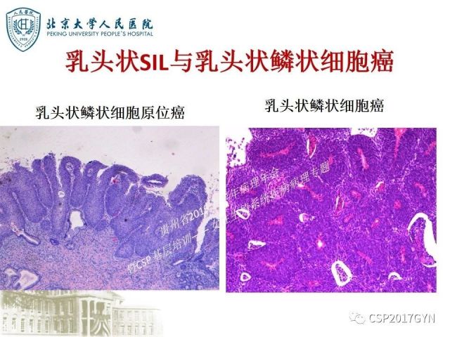 中华病理学会基层培训遵义站讲座（三）——宫颈鳞状上皮病变的病理诊断与鉴别诊断