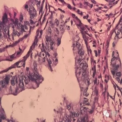 交界性黏液性囊腺瘤？癌？（魏娉分享，刘从容老师讲解）