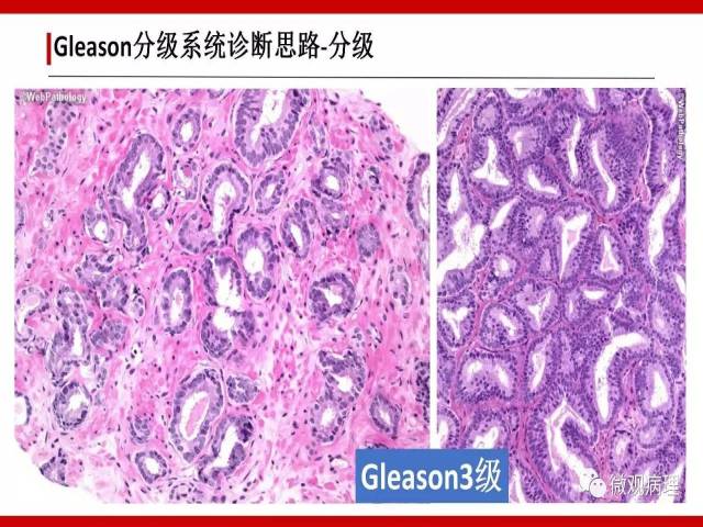 前列腺癌Gleason分级系统的前世今生